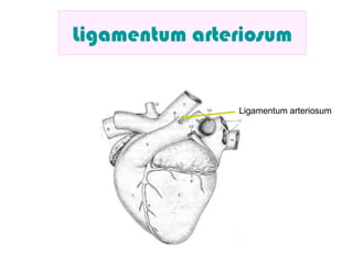 Ligamentum arteriosum
Ligamentum arteriosum
 