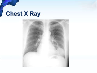Chest X Ray
 