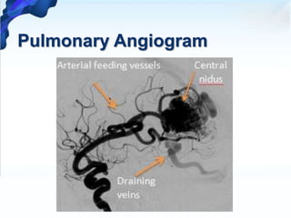 Pulmonary Angiogram
 