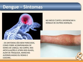 Dengue – Sintomas
. OS SINTOMAS SÃO BEM PARECIDOS,
COMO FEBRE ACOMPANHADA DE
DORES DE CABEÇA, NO CORPO, NAS
ARTICULAÇÕES E ATRÁS DOS OLHOS,
ALÉM DE FRAQUEZA, MANCHAS
AVERMELHADAS OU ROXAS E
COCEIRA..
NO INÍCIO É DIFÍCIL DIFERENCIAR A
DENGUE DE OUTRAS DOENÇAS.
 