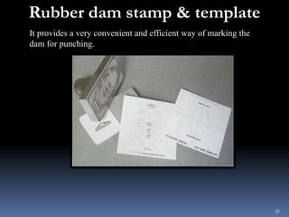 Rubber dam stamp & template
It provides a very convenient and efficient way of marking the
dam for punching.
35
 