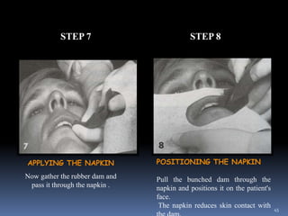 STEP 7 STEP 8
APPLYING THE NAPKIN
Now gather the rubber dam and
pass it through the napkin .
POSITIONING THE NAPKIN
Pull t...