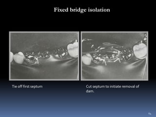 Fixed bridge isolation
64
Tie off first septum Cut septum to initiate removal of
dam.
 