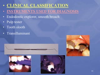• CLINICAL CLASSIFICATION
• INSTRUMENTS USED FOR DIAGNOSIS
• Endodontic explorer, smooth broach
• Pulp tester
• Tooth slooth
• Transilluminant
14
 