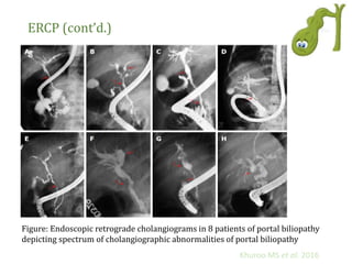 ERCP (cont’d.)
Figure: Endoscopic retrograde cholangiograms in 8 patients of portal biliopathy
depicting spectrum of cholangiographic abnormalities of portal biliopathy
Khuroo MS et al. 2016
 