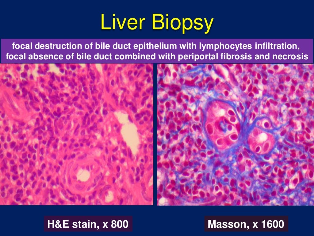 Primary biliary cirrhosis and autoimmune hepatitis 20120902