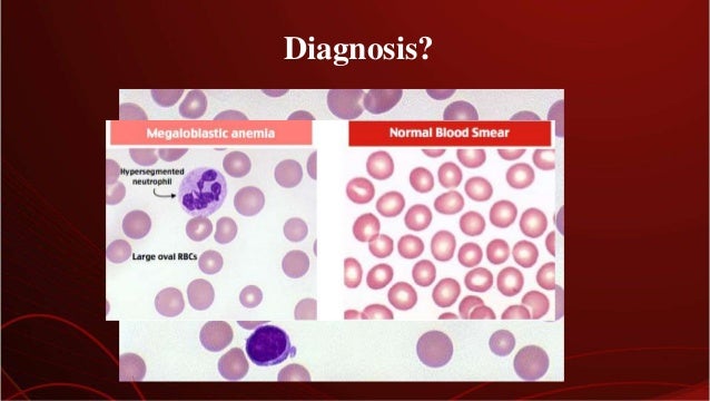 peripheral blood smear spot diagnosis