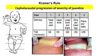 Kramer Test Comprehensive Overview of Neonatal Jaundice: Causes, Diagnosis, and ...