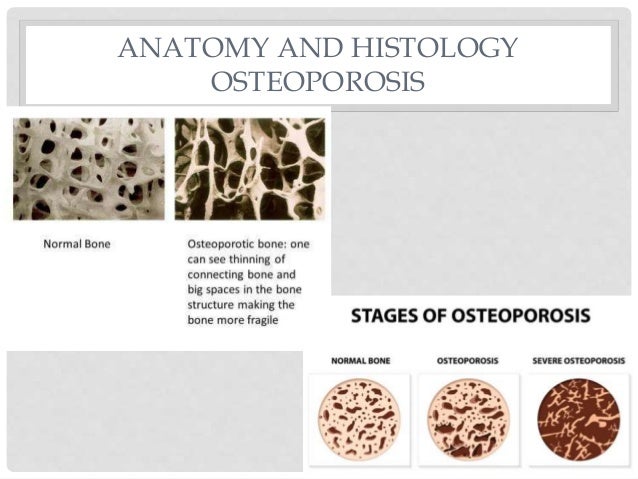 Osteoporosis