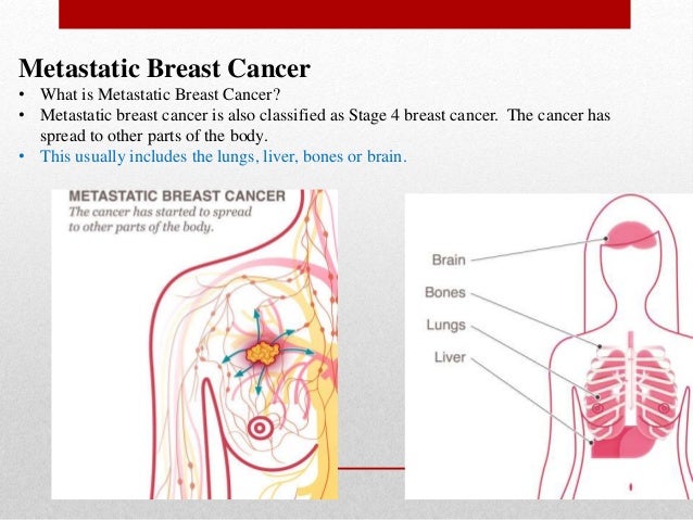 what is the most common site for breast cancer what is the most common site for breast cancer