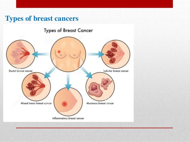 Breast Cancer Types