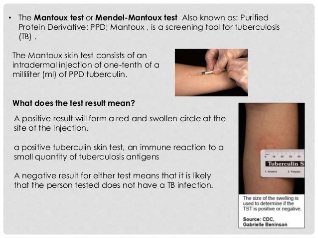 Test pictures tb positive skin Test pictures tb positive skin
