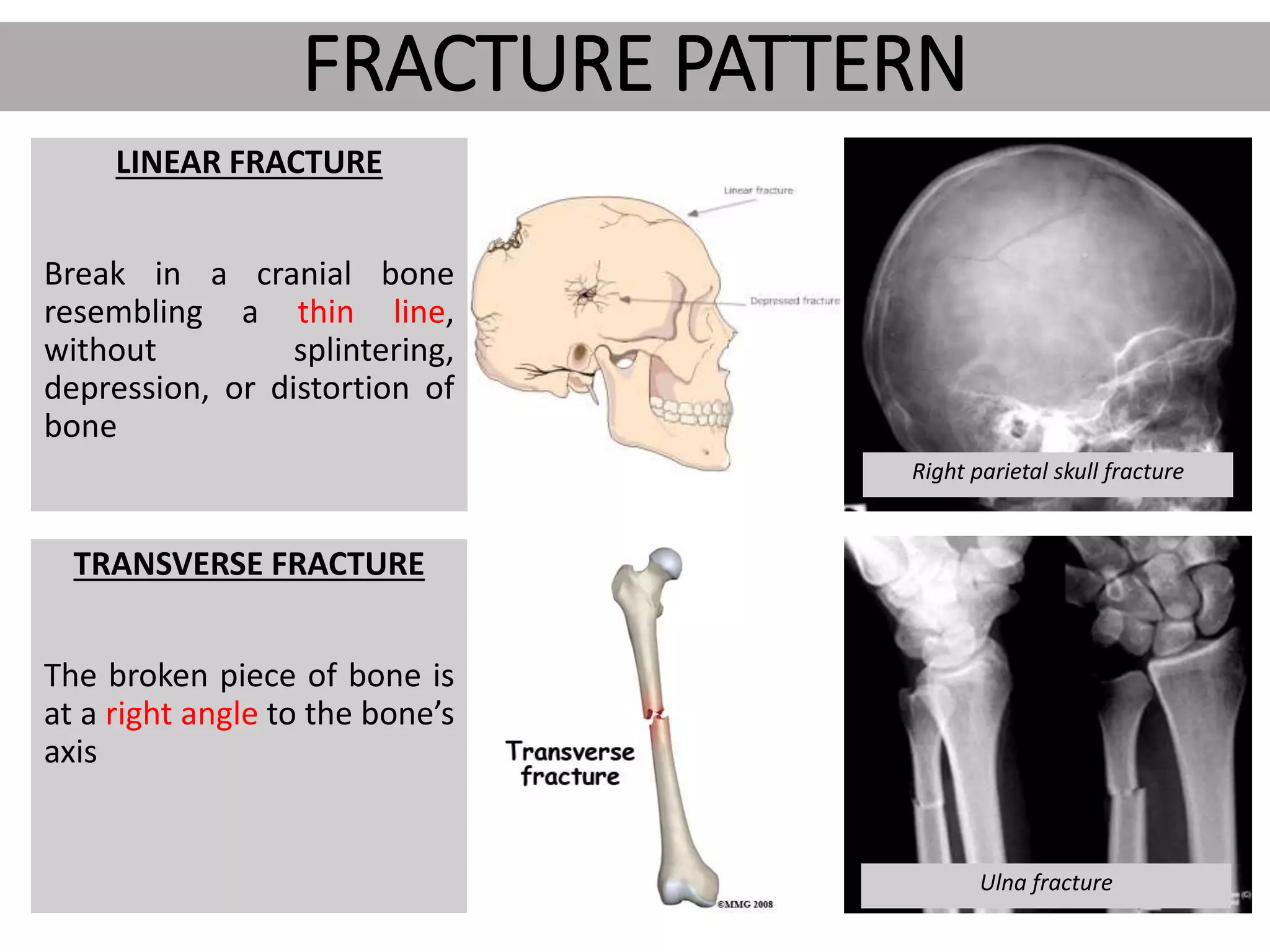 Types of Fractures | PPTX