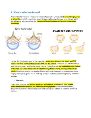 4. What are disc herniations?
A spinal disc herniation is a medical condition affecting the spine due to trauma, lifting injuries,
or idiopathic, in which a tear in the outer, fibrous ring (annulus fibrosus) of an intervertebral
disc allows the soft, central portion (nucleus pulposus) to bulge out beyond the damaged
outer rings.
Lumbar disc herniations occur in the lower back, most often between the fourth and fifth
lumbar vertebral bodies or between the fifth and the sacrum. Symptoms can affect the lower
back, buttocks, thigh, anal/genital region (via the Perineal nerve), and may radiate into the foot
and/or toe. The sciatic nerve is the most commonly affected nerve, causing symptoms of
sciatica. The femoral nerve can also be affected and cause the patient to experience a numb,
tingling feeling throughout one or both legs and even feet or even a burning feeling in the hips
and legs.
• Diagnosis:
Diagnosis is based on the history, symptoms, and physical examination. tests may be
performed to confirm or rule out other causes of symptoms such as spondylolisthesis,
degeneration, tumors, metastases as well as to evaluate the efficacy of potential treatment
options.
 