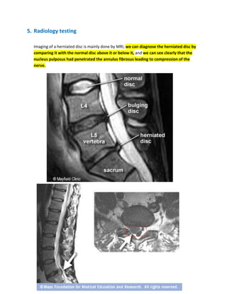 5. Radiology testing
Imaging of a herniated disc is mainly done by MRI, we can diagnose the herniated disc by
comparing it with the normal disc above it or below it, and we can see clearly that the
nucleus pulposus had penetrated the annulus fibrosus leading to compression of the
nerve.
 