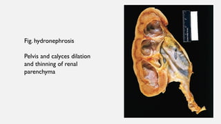 Fig. hydronephrosis
Pelvis and calyces dilation
and thinning of renal
parenchyma
 