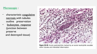Microscopic :
- characteristic coagulative
necrosis with tubules
outline preservation
- leukocytes response
(junction between
preserve
and destroyed tissue)
 