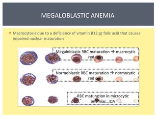 Macrocytosis due to a deficiency of vitamin B12  or  folic acid that causes impaired nuclear maturation  MEGALOBLASTIC ANEMIA   RBC maturation in microcytic anemias…IDA Normoblastic RBC maturation    normocytic red cells Megaloblastic RBC maturation    macrocytic red cells 