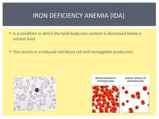 Is a condition in which the total body iron content is decreased below a normal level This results in a reduced red blood cell and hemoglobin production IRON DEFICIENCY ANEMIA (IDA)  