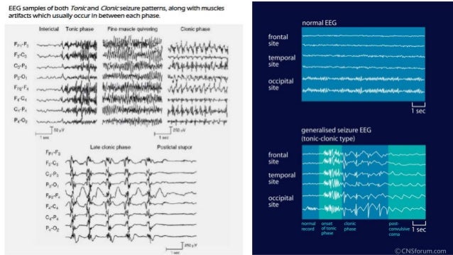 eeg epilepsy vs normal eeg epilepsy vs normal