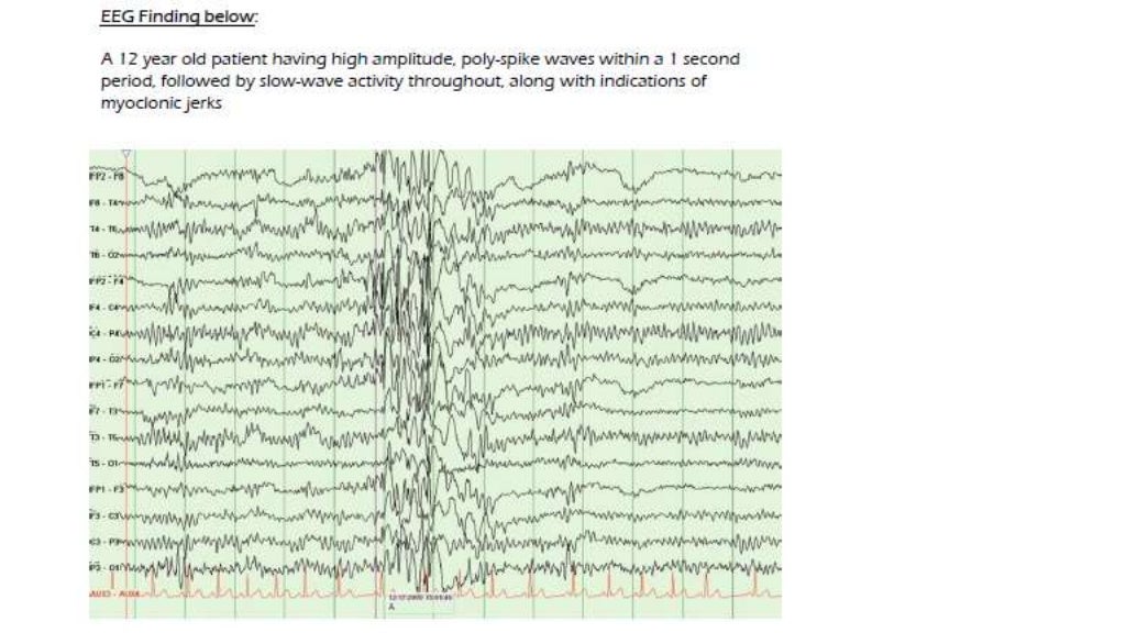 EEG Epilepsy