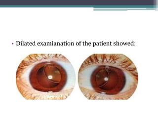 • Dilated examianation of the patient showed:
 