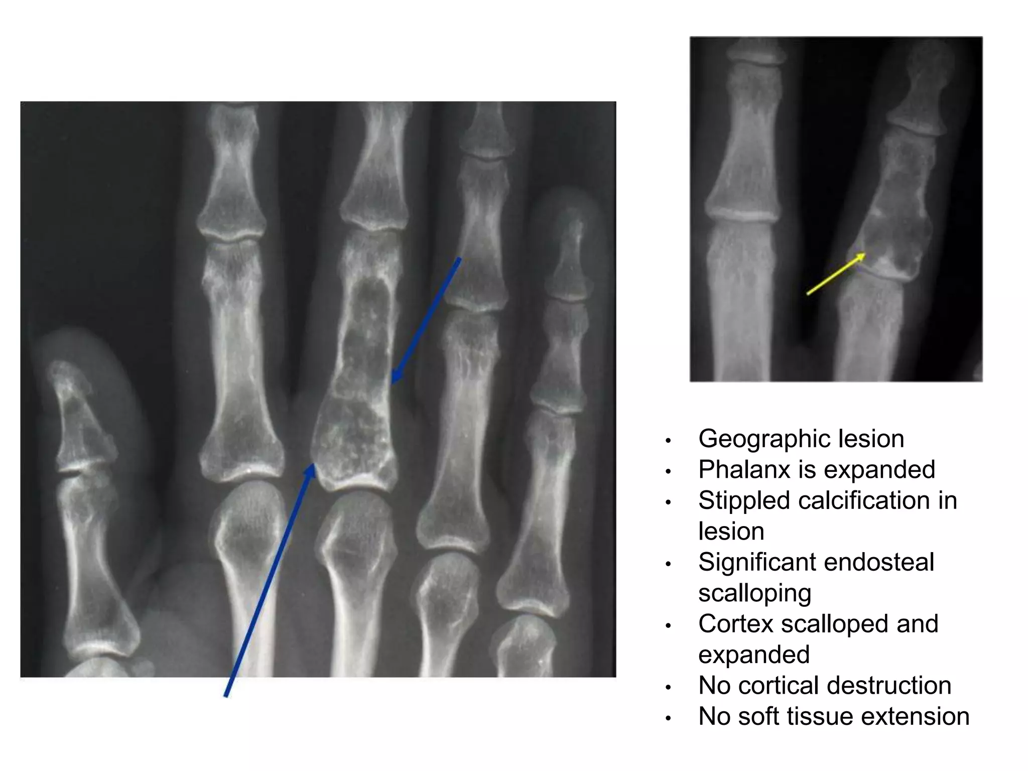 • Geographic lesion
• Phalanx is expanded
• Stippled calcification in
lesion
• Significant endosteal
scalloping
• Cortex scalloped and
expanded
• No cortical destruction
• No soft tissue extension
 