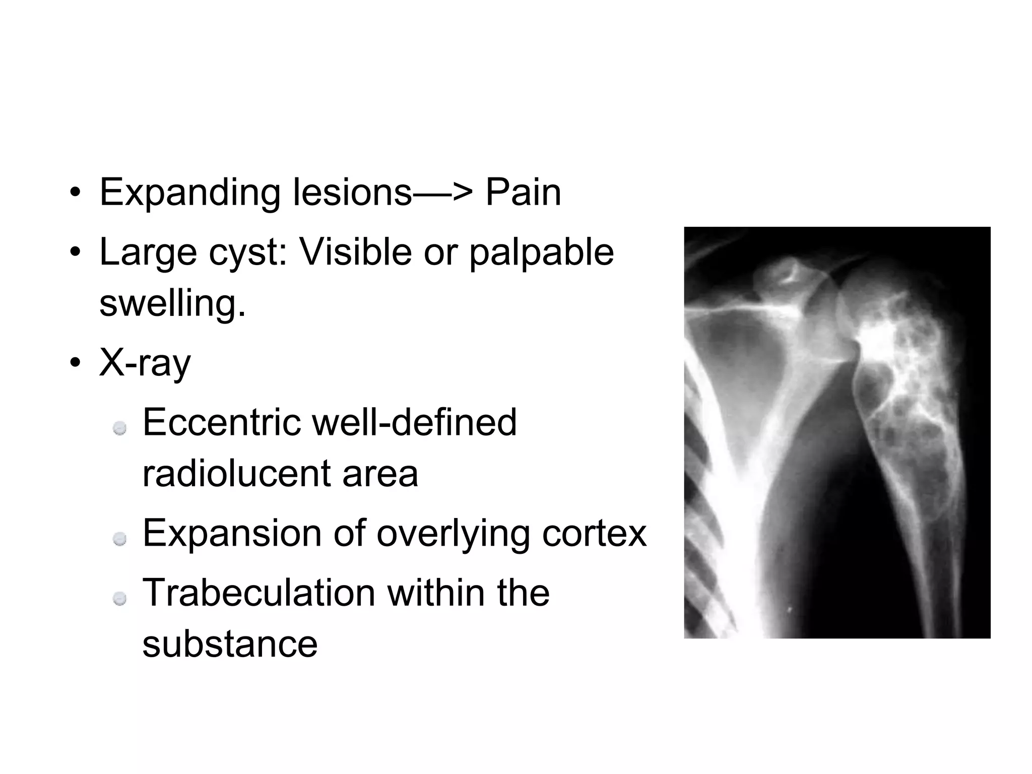 • Expanding lesions—> Pain
• Large cyst: Visible or palpable
swelling.
• X-ray
Eccentric well-defined
radiolucent area
Expansion of overlying cortex
Trabeculation within the
substance
 