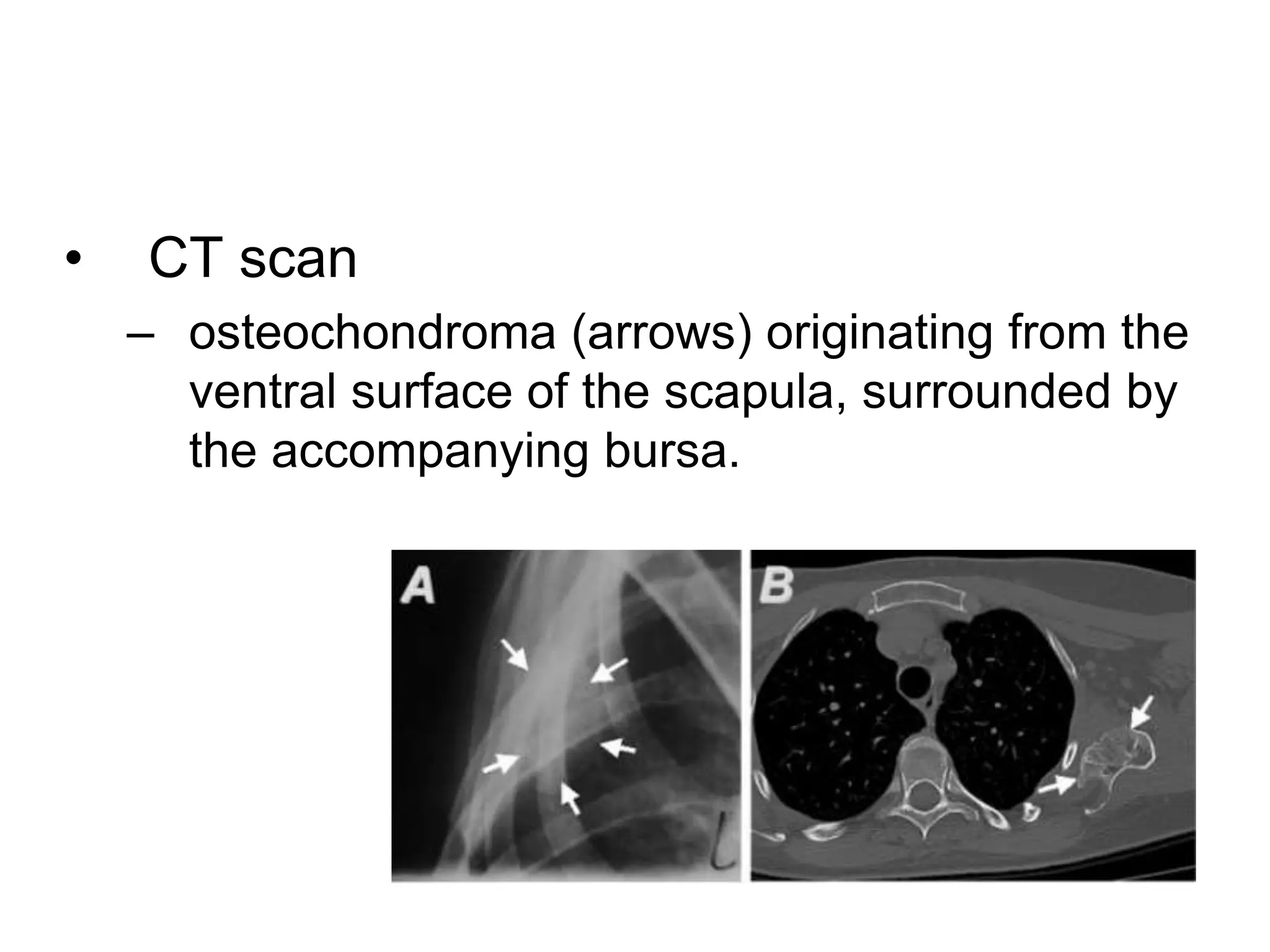 • CT scan
– osteochondroma (arrows) originating from the
ventral surface of the scapula, surrounded by
the accompanying bursa.
 