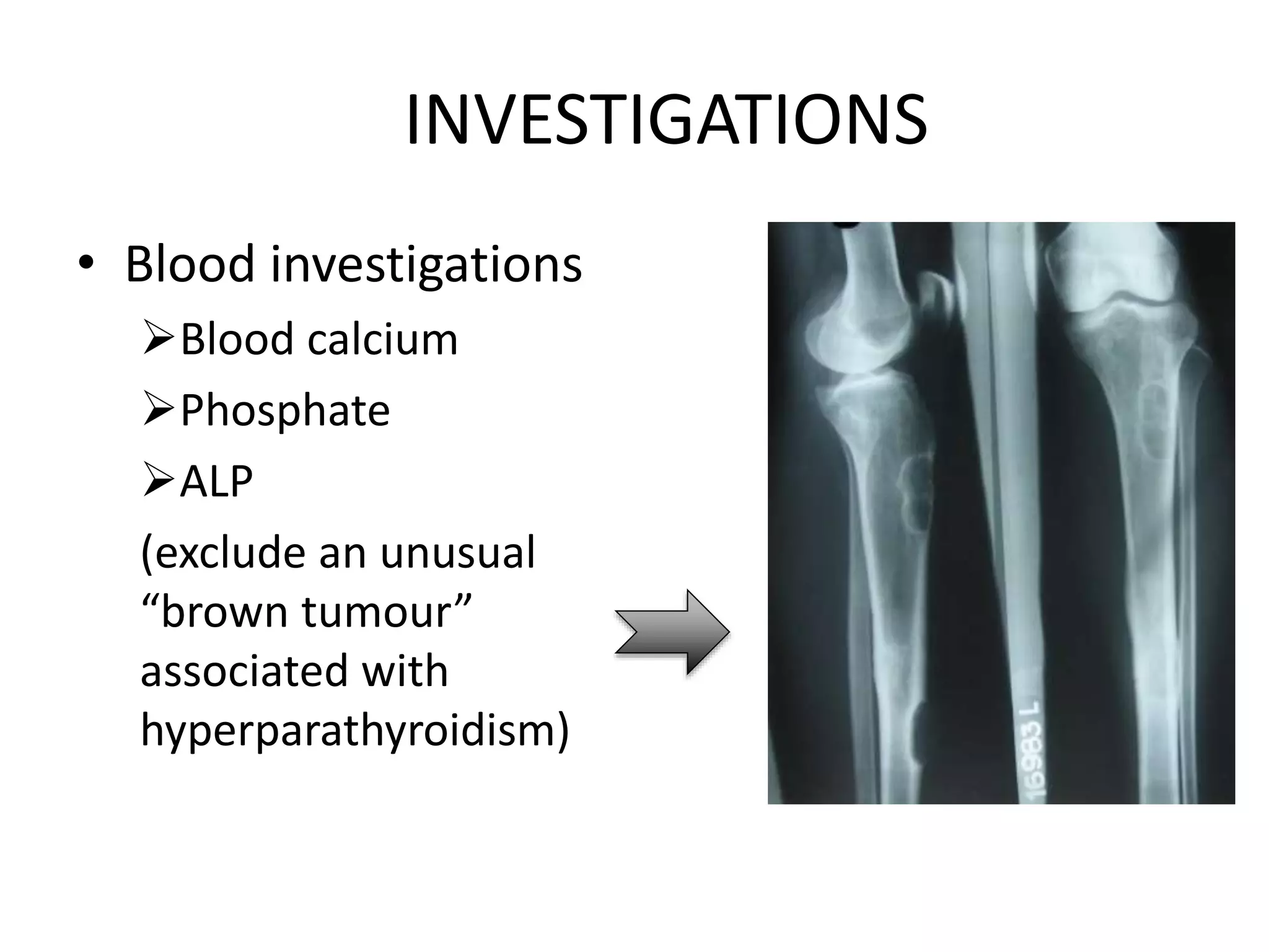 INVESTIGATIONS
• Blood investigations
Blood calcium
Phosphate
ALP
(exclude an unusual
“brown tumour”
associated with
hyperparathyroidism)
 