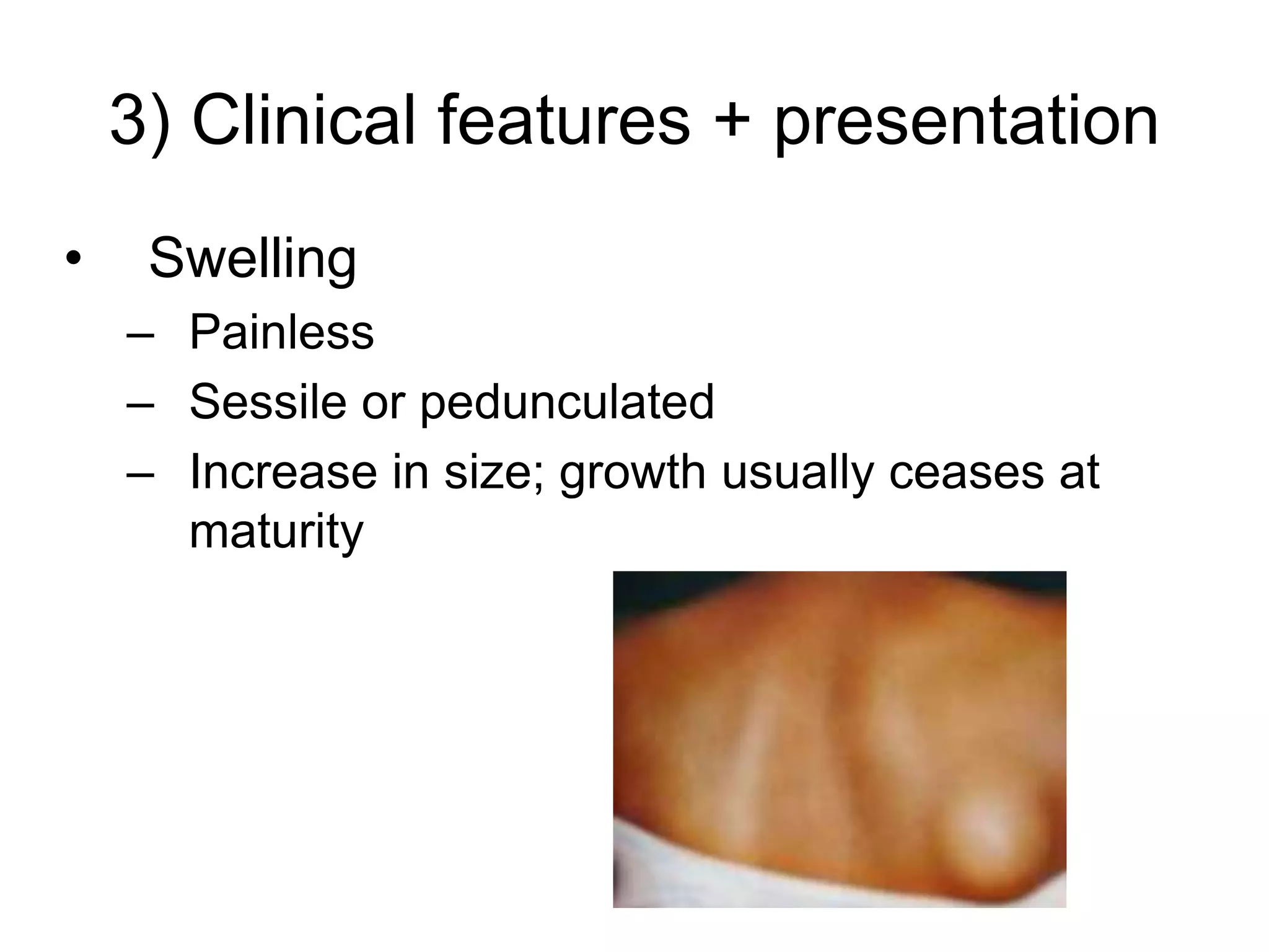 3) Clinical features + presentation
• Swelling
– Painless
– Sessile or pedunculated
– Increase in size; growth usually ceases at
maturity
 