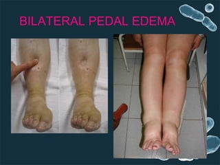 BILATERAL PEDAL EDEMA
 