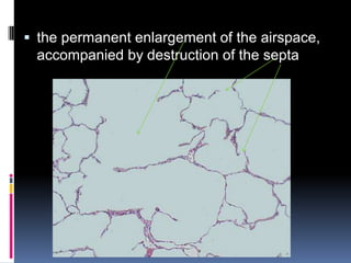  the permanent enlargement of the airspace,
 accompanied by destruction of the septa
 