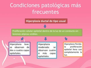 Condiciones patológicas más
frecuentes
Hiperplasia ductal de tipo usual
Proliferación celular epitelial dentro de la luz de un conducto sin
lesiones atípicas visibles.
Hiperplasia leve:
se observan de
dos a cuatro capas
epiteliales.
Hiperplasia
moderada: se
observan cuatro
o más capas
epiteliales.
Hiperplasia florida:
la proliferación
epitelial llena casi
completamente la
luz.
 