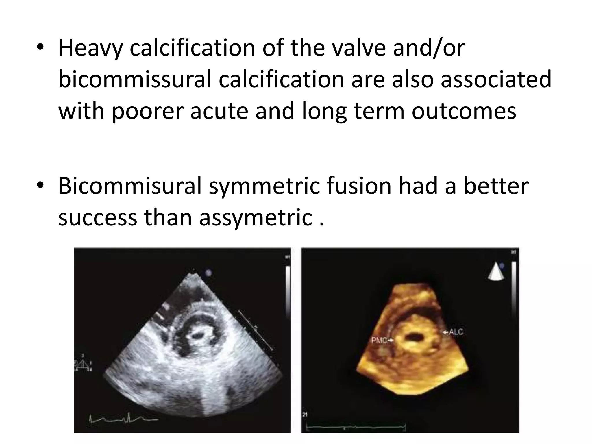 • Heavy calcification of the valve and/or
bicommissural calcification are also associated
with poorer acute and long term outcomes
• Bicommisural symmetric fusion had a better
success than assymetric .
 