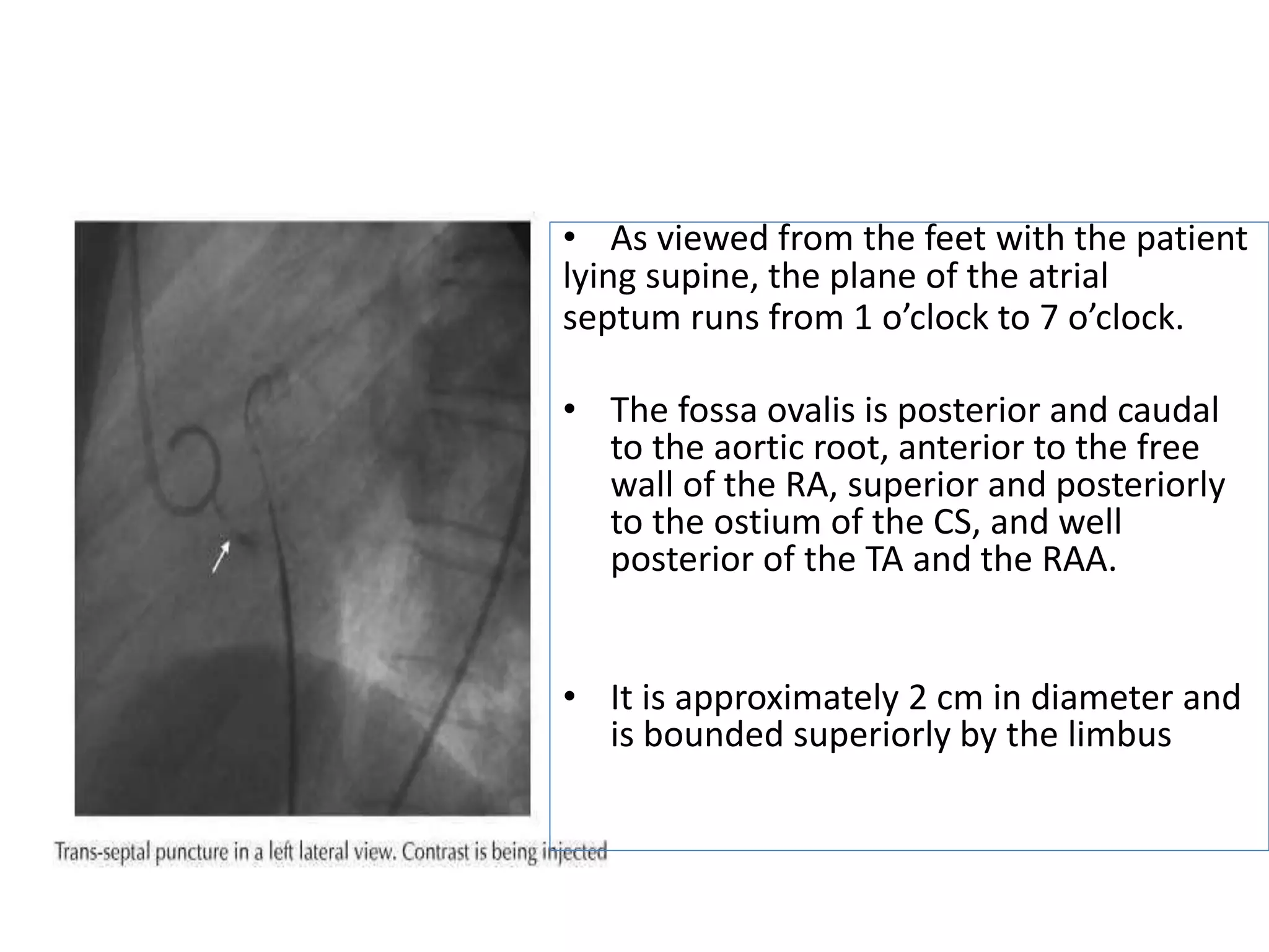 • As viewed from the feet with the patient
lying supine, the plane of the atrial
septum runs from 1 o’clock to 7 o’clock.
• The fossa ovalis is posterior and caudal
to the aortic root, anterior to the free
wall of the RA, superior and posteriorly
to the ostium of the CS, and well
posterior of the TA and the RAA.
• It is approximately 2 cm in diameter and
is bounded superiorly by the limbus
 