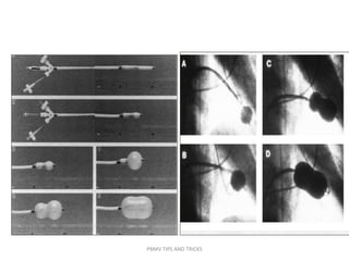 PBMV TIPS AND TRICKS
 