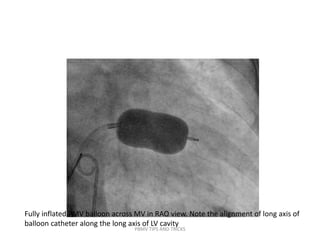 Fully inflated PMV balloon across MV in RAO view. Note the alignment of long axis of
balloon catheter along the long axis of LV cavity
PBMV TIPS AND TRICKS
 
