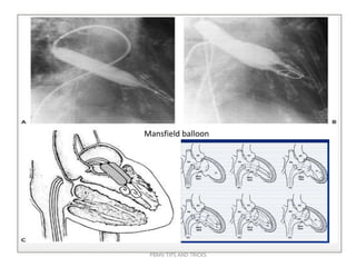 Mansfield balloon
PBMV TIPS AND TRICKS
 