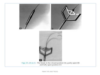 PBMV TIPS AND TRICKS
 