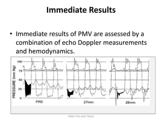 Immediate Results
• Immediate results of PMV are assessed by a
combination of echo Doppler measurements
and hemodynamics.
PBMV TIPS AND TRICKS
 