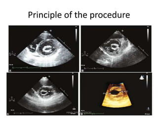 Principle of the procedure
PBMV TIPS AND TRICKS
 