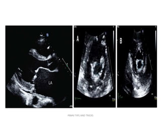 PBMV TIPS AND TRICKS
 