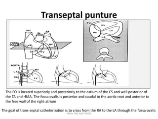 Transeptal punture
The goal of trans-septal catheterization is to cross from the RA to the LA through the fossa ovalis
The FO is located superiorly and posteriorly to the ostium of the CS and well posterior of
the TA and rRAA. The fossa ovalis is posterior and caudal to the aortic root and anterior to
the free wall of the right atrium
PBMV TIPS AND TRICKS
 