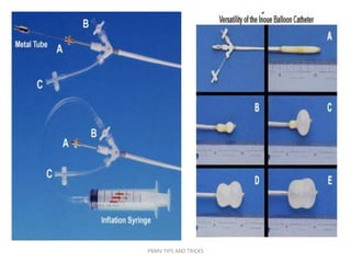 PBMV TIPS AND TRICKS
 