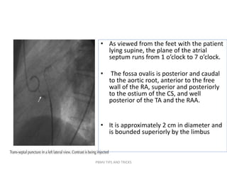• As viewed from the feet with the patient
lying supine, the plane of the atrial
septum runs from 1 o’clock to 7 o’clock.
• The fossa ovalis is posterior and caudal
to the aortic root, anterior to the free
wall of the RA, superior and posteriorly
to the ostium of the CS, and well
posterior of the TA and the RAA.
• It is approximately 2 cm in diameter and
is bounded superiorly by the limbus
PBMV TIPS AND TRICKS
 