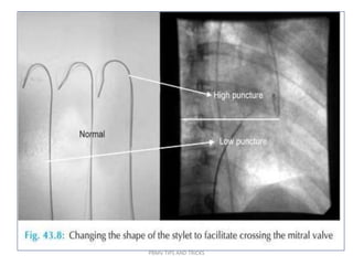 PBMV TIPS AND TRICKS
 
