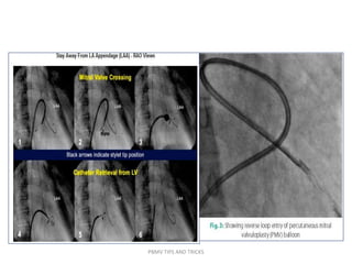 PBMV TIPS AND TRICKS
 
