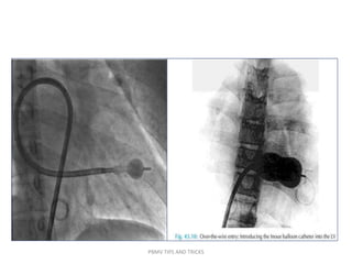PBMV TIPS AND TRICKS
 