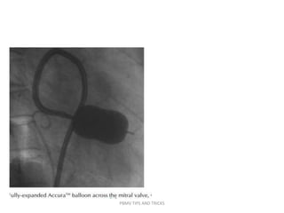 PBMV TIPS AND TRICKS
 